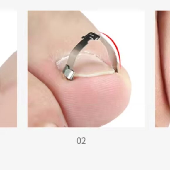 Ingrown Toenail Straightening Clip Stainless Steel Toenail Correction Clip Toe - Picture 1 of 8